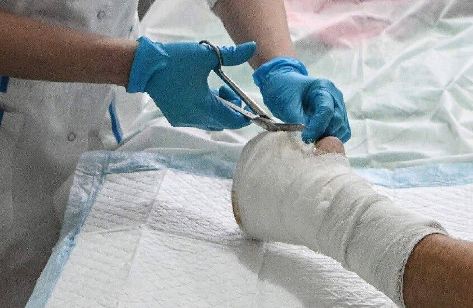 غرسات قابلة للتحلل الحيوي بمضاد حيوي لمكافحة العدوى بعد الإصابات