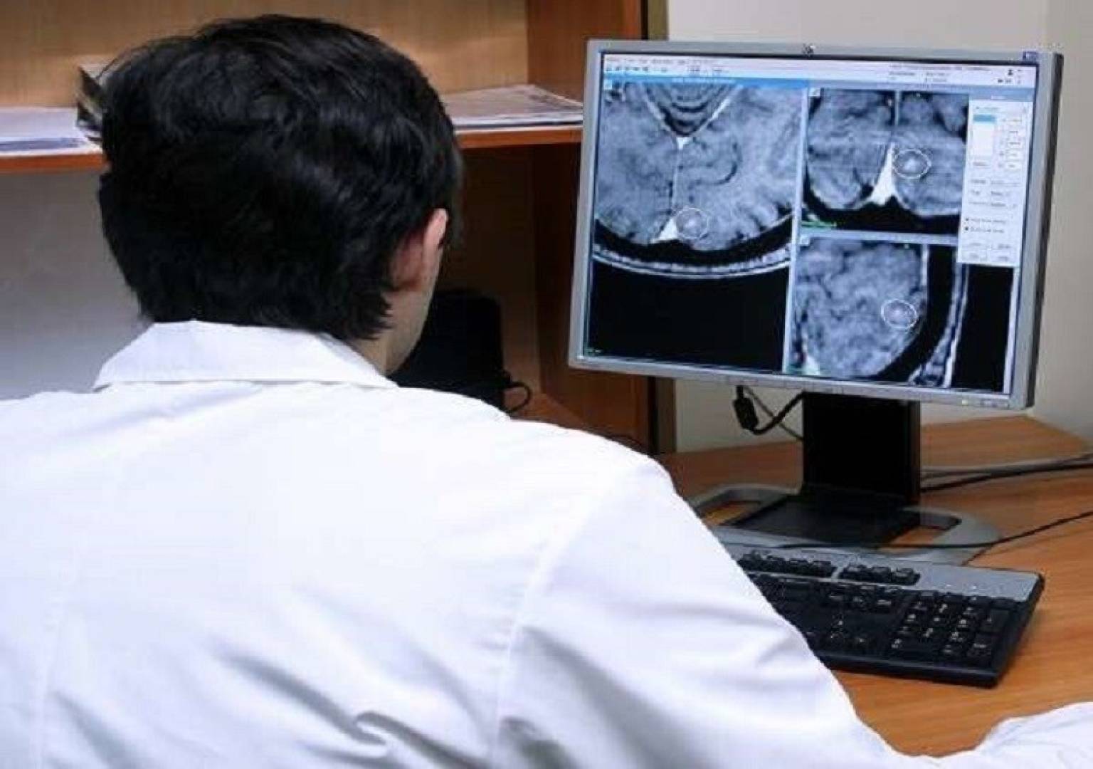 الجلطة الدماغية الدقيقة لا تقل خطورة عن الكاملة