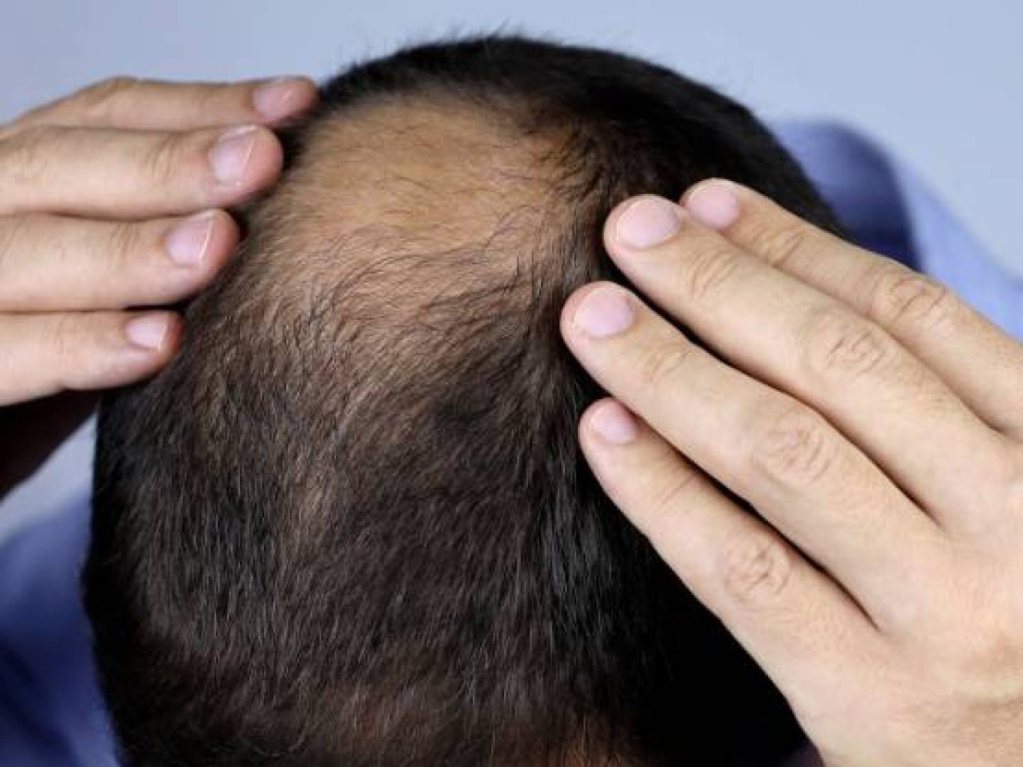 اكتشاف سكر طبيعي يعيد إنبات الشعر بكثافة خلال أسابيع