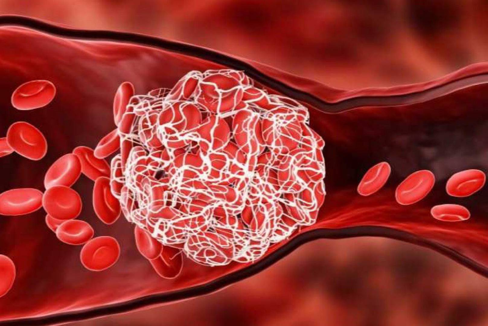 أسباب وأعراض الجلطات الدموية وطرق الوقاية والعلاج