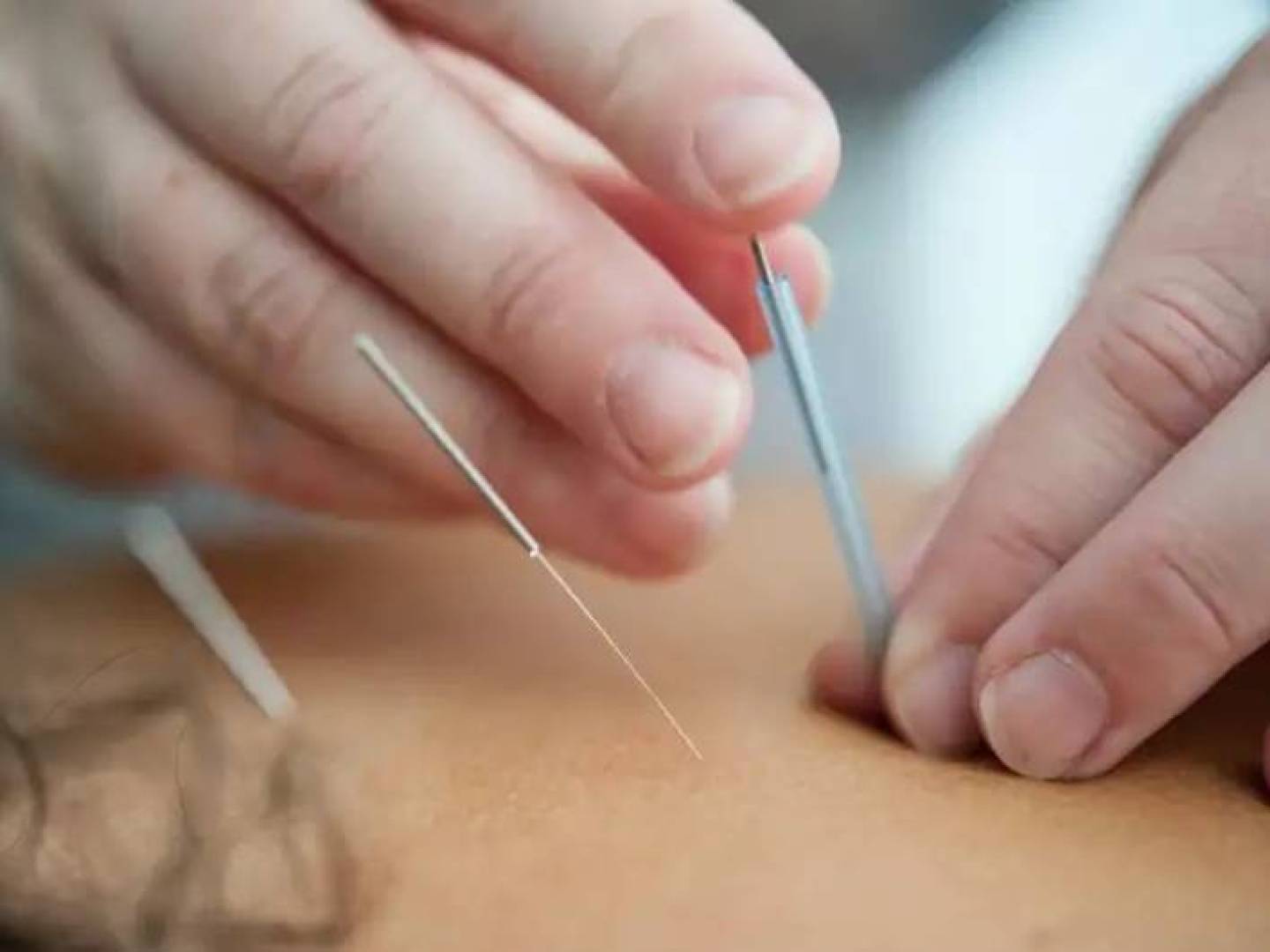 اكتشف حقيقة الوخز بالإبر الصينية لآلام الظهر