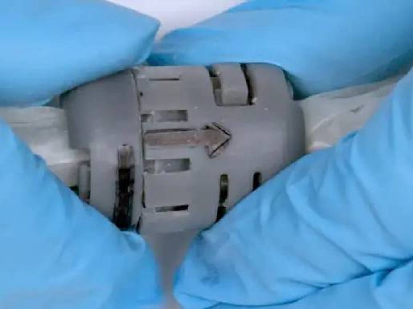 ابتكار جهاز طبي جديد يمنع نزيف ما بعد الولادة