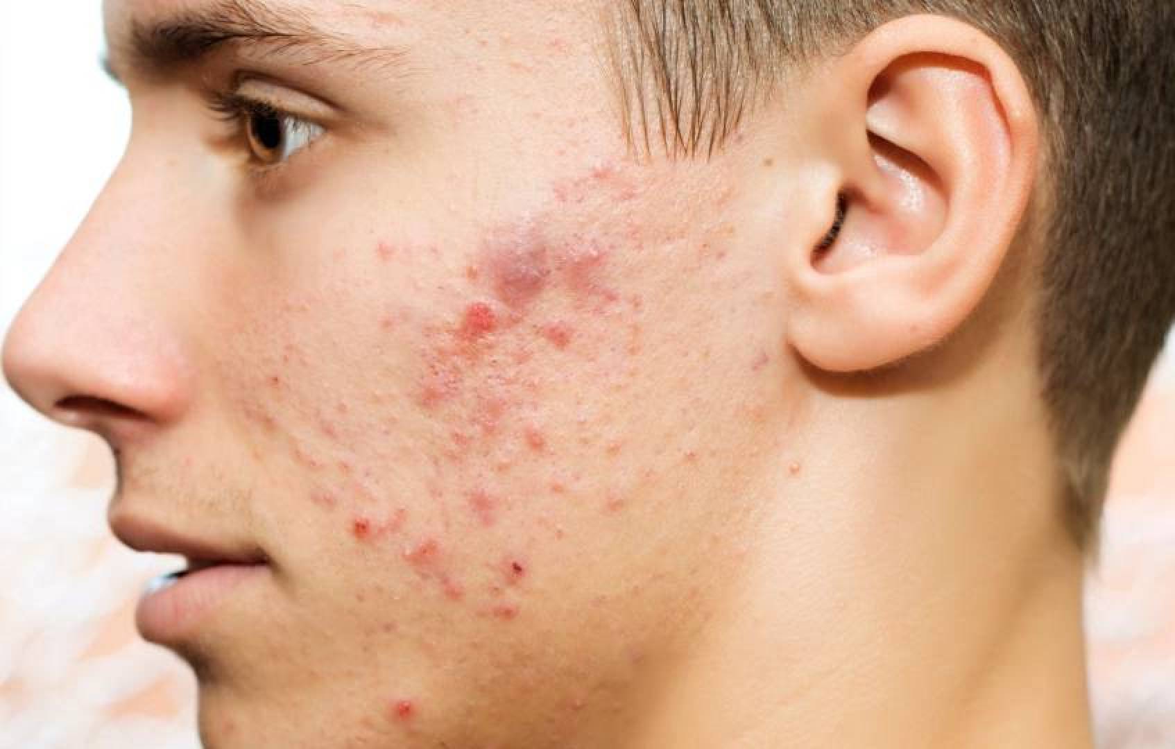 أسباب حب الشباب وأنواعه وطريقة علاجه بفعالية