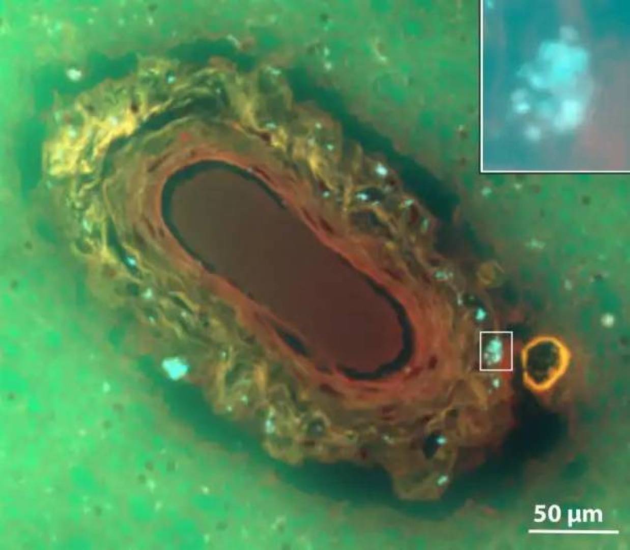 تعرف على العلاقة بين أمراض الأوعية الدموية والخرف تعرف على العلاقة بين أمراض الأوعية الدموية والخرف