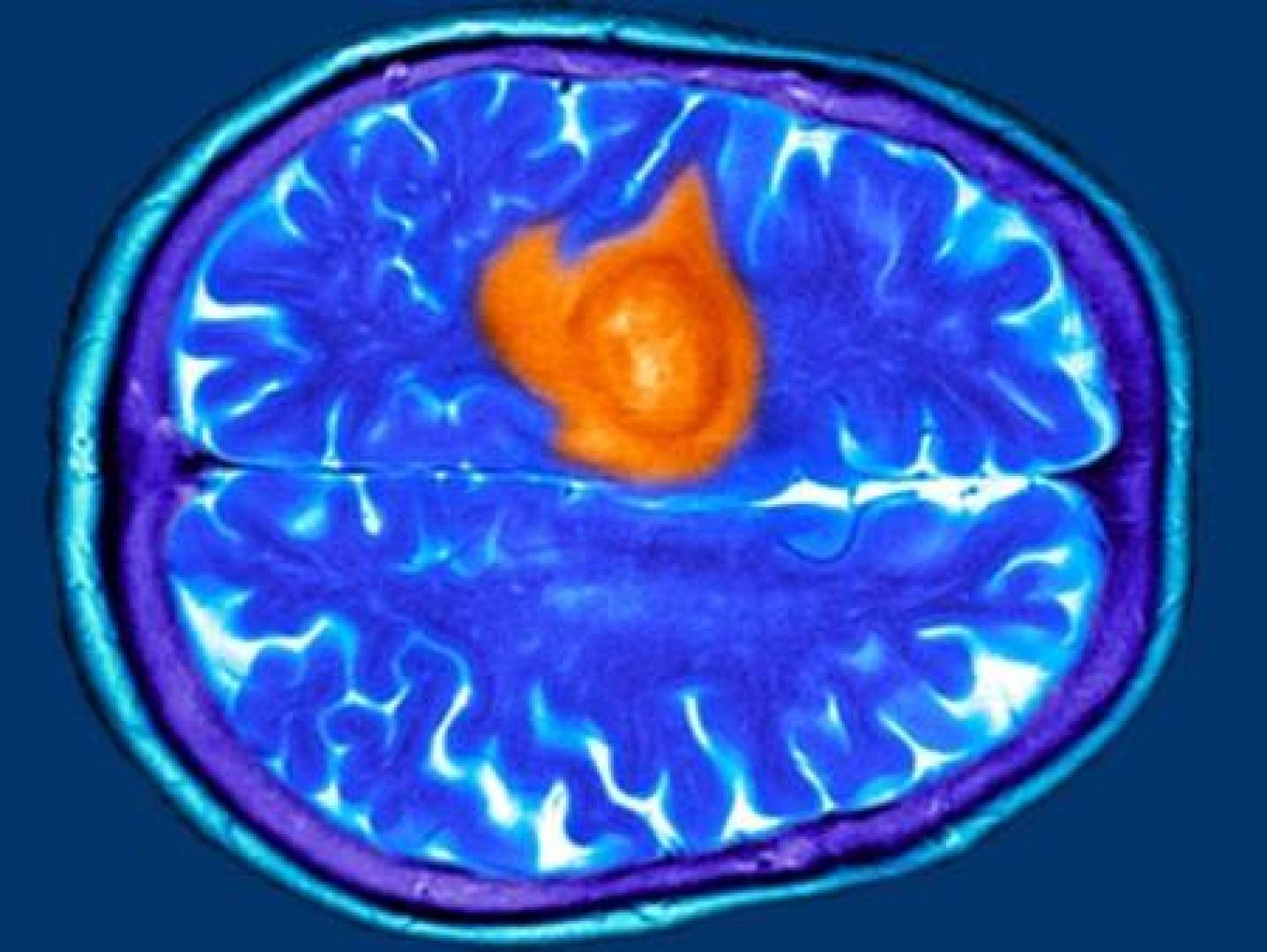 أعراض شائعة تخفي ورما خطيرا في الدماغ