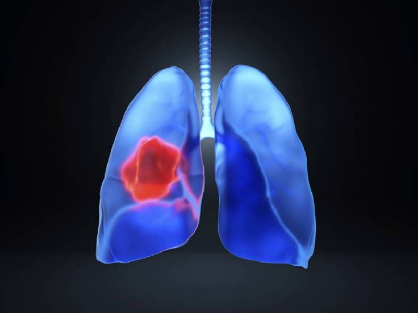اكتشاف المحرك الرئيسي لتطور سرطان الرئة في مراحله المبكرة