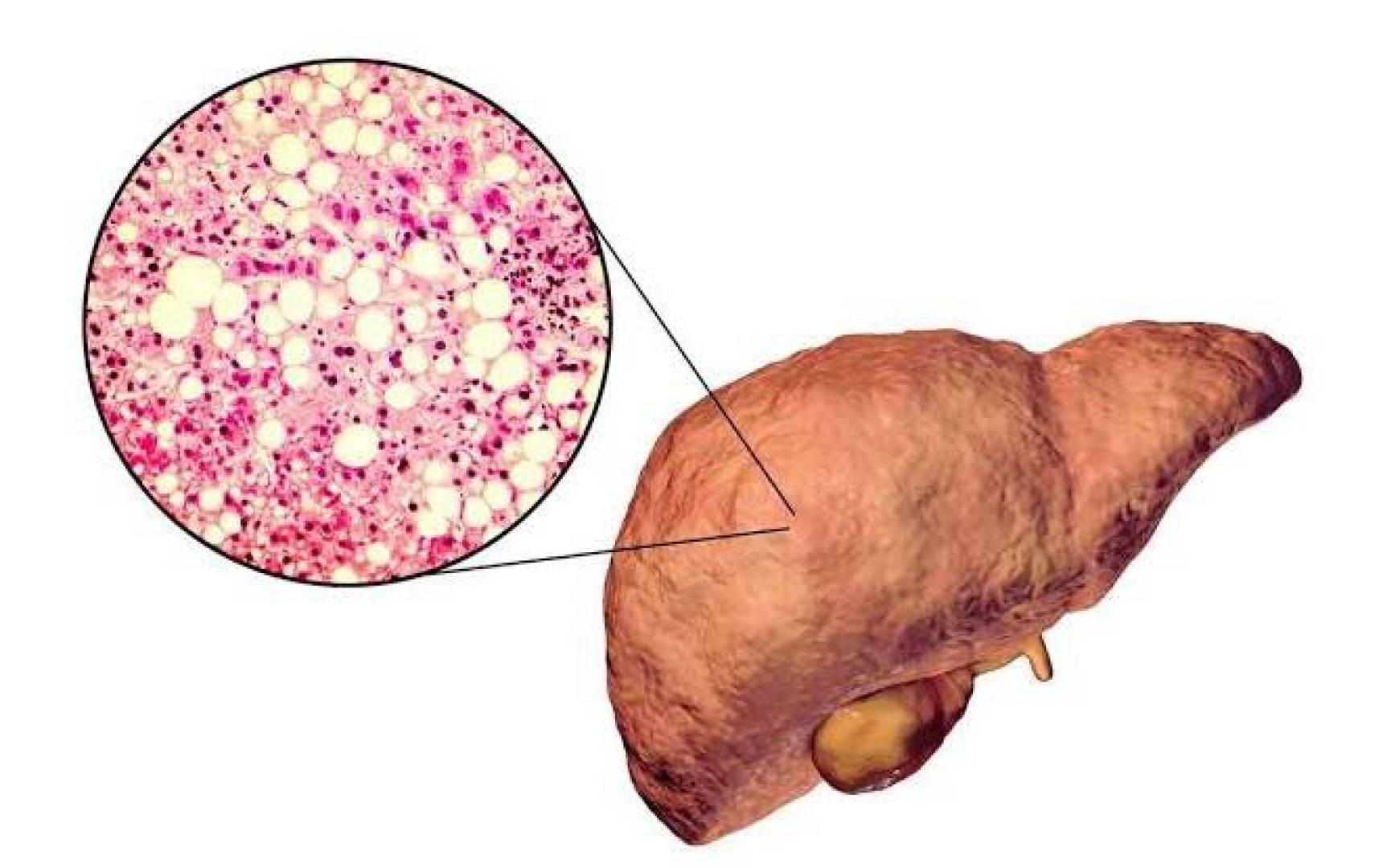 اكتشاف بروتين قد يكون المفتاح لعلاج مرض الكبد الدهني الأيضي ومنع تطوره اكتشاف بروتين قد يكون المفتاح لعلاج مرض الكبد الدهني الأيضي ومنع تطوره