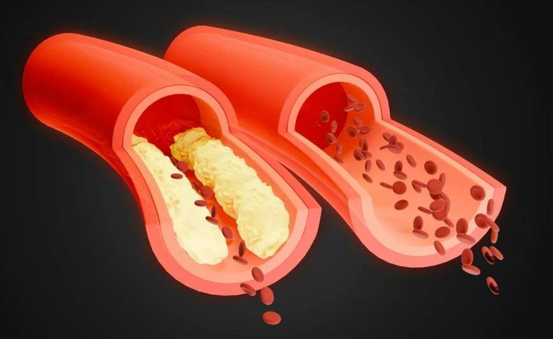 أداة جديدة للتنبؤ بمخاطر الكولسترول الضار والأمراض القلبية