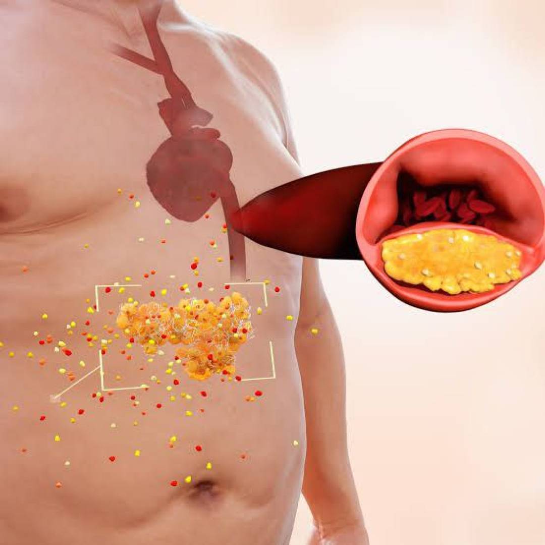 العلاقة بين الدهون الخفية وتلف الشرايين الصامت العلاقة بين الدهون الخفية وتلف الشرايين الصامت