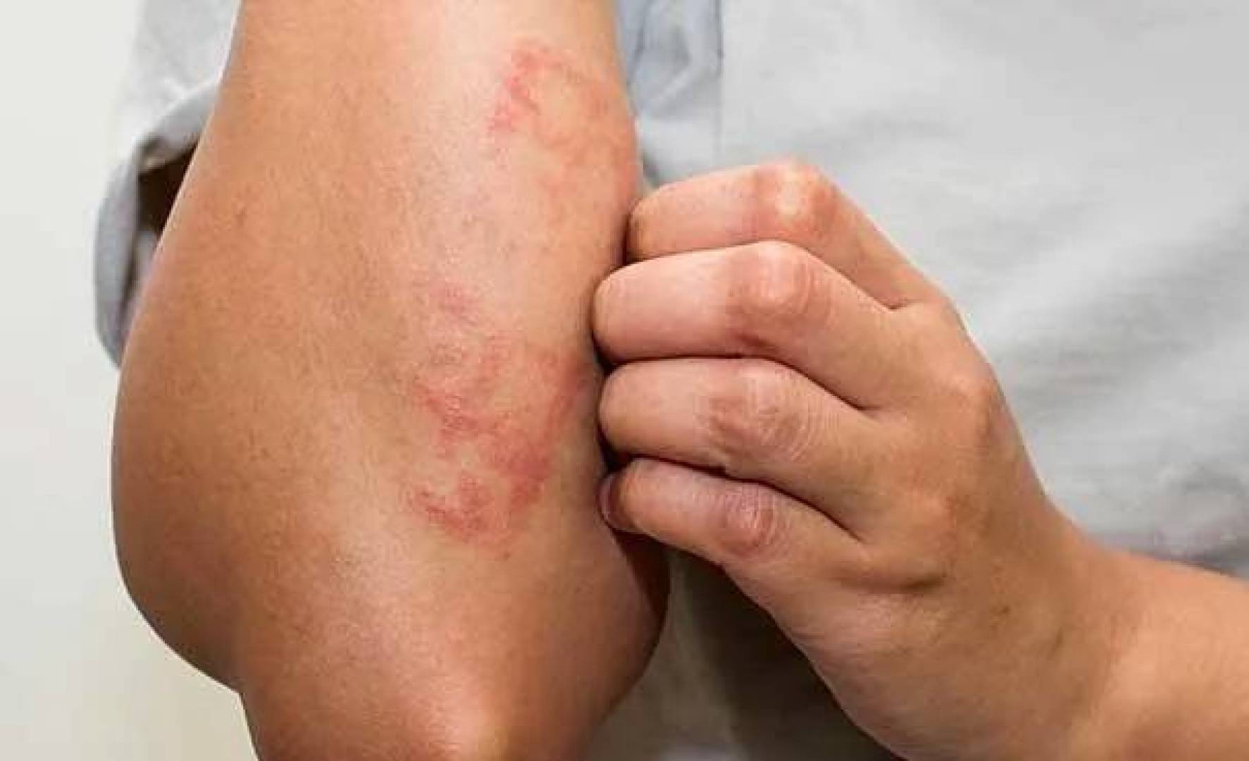 تثر التغذية في علاج الإكزيما.. تهدئ الالتهاب وتحسن صحة الجلد