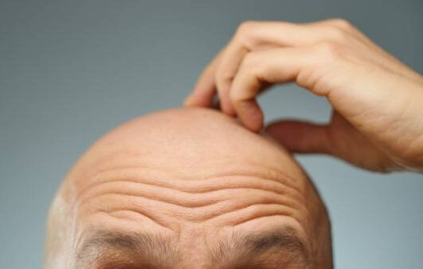 خلايا الدهون قد تكون مفتاح لعلاج الصلع مستقبلا