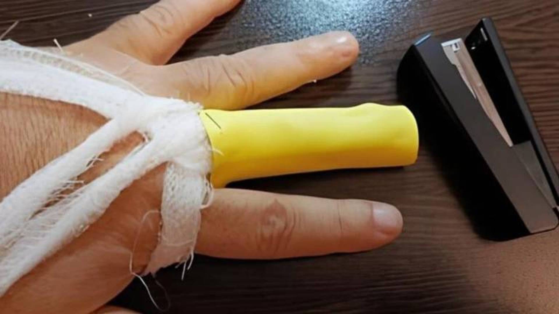 ابتكار دعامة ذكية للأصابع تعيد التأهيل وتتكيف مع التورم وتسرع الشفاء من الكسور