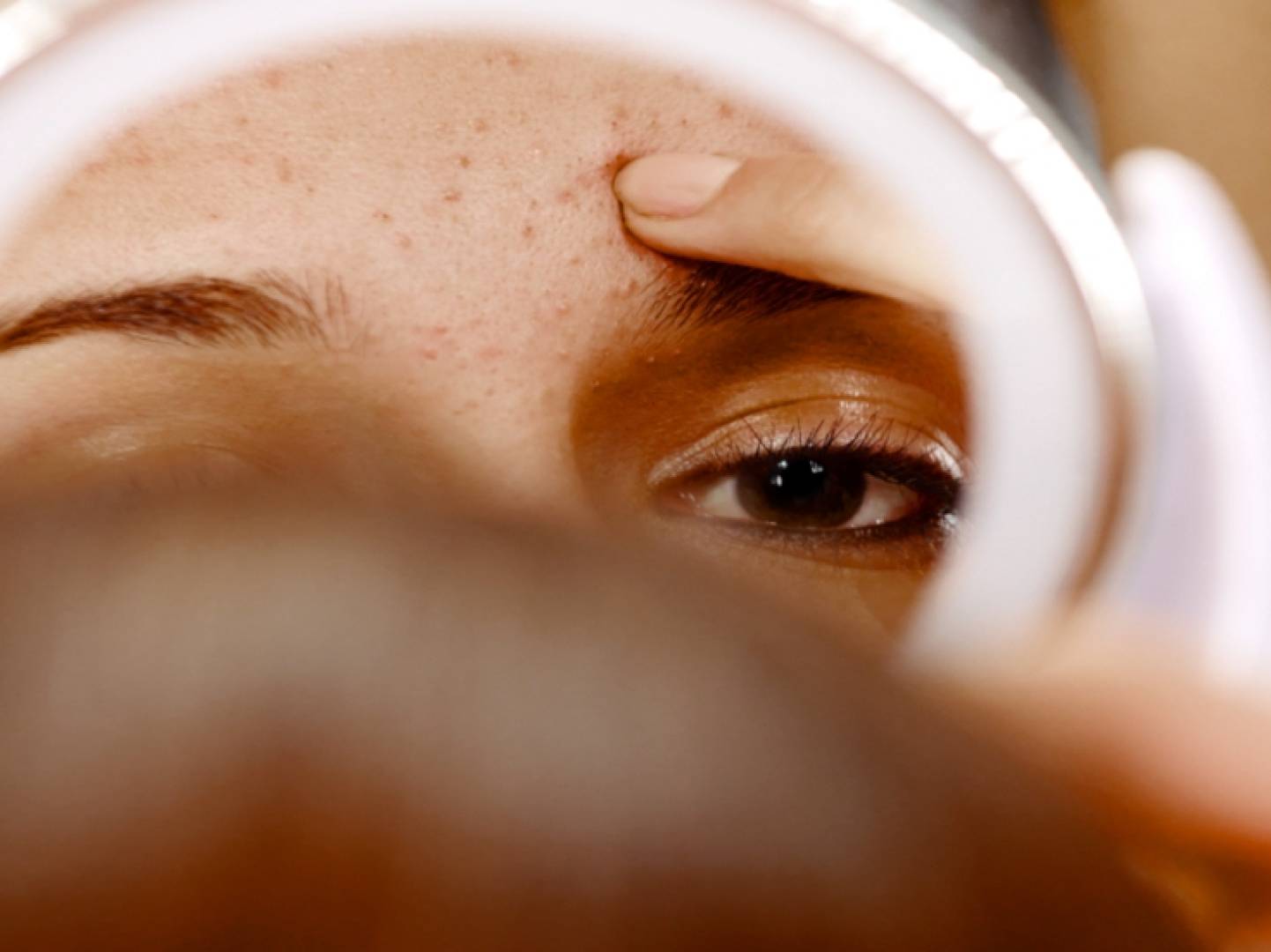 لقاحان جديدان قد يقضيان على حب الشباب نهائيا