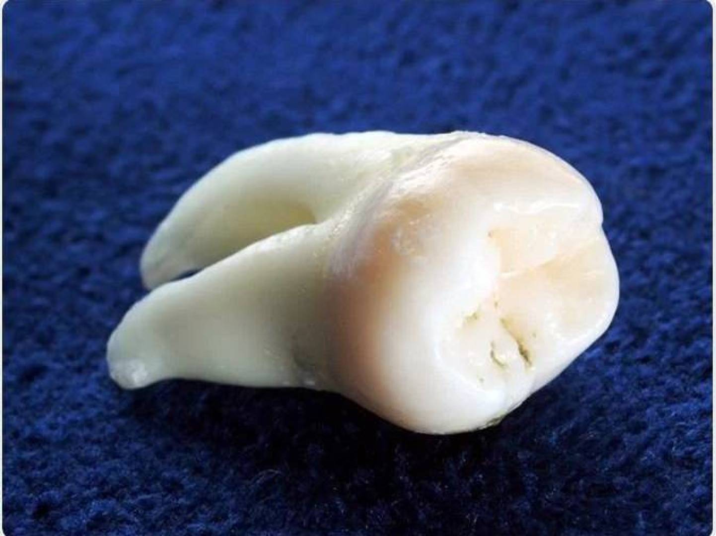 خلايا ضرس العقل الجذعية لعلاج أمراض القلب والزهايمر خلايا ضرس العقل الجذعية لعلاج أمراض القلب والزهايمر