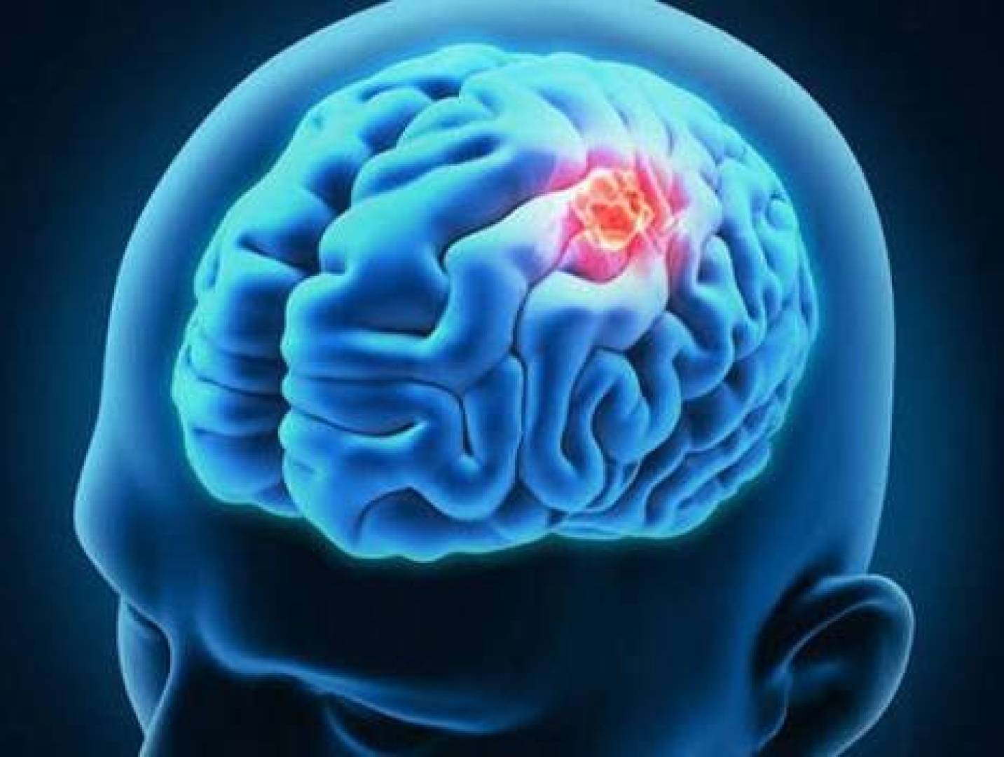 ابتكار جل دوائي طبي لمكافحة أورام الدماغ