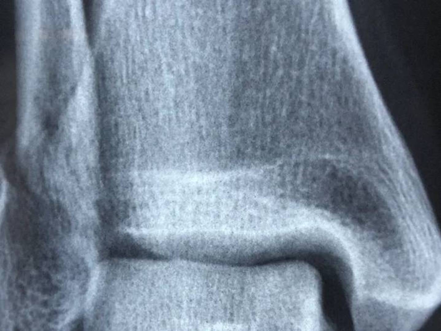 أدوية تخفيف الألم تبطئ نمو سرطان العظام أدوية تخفيف الألم تبطئ نمو سرطان العظام