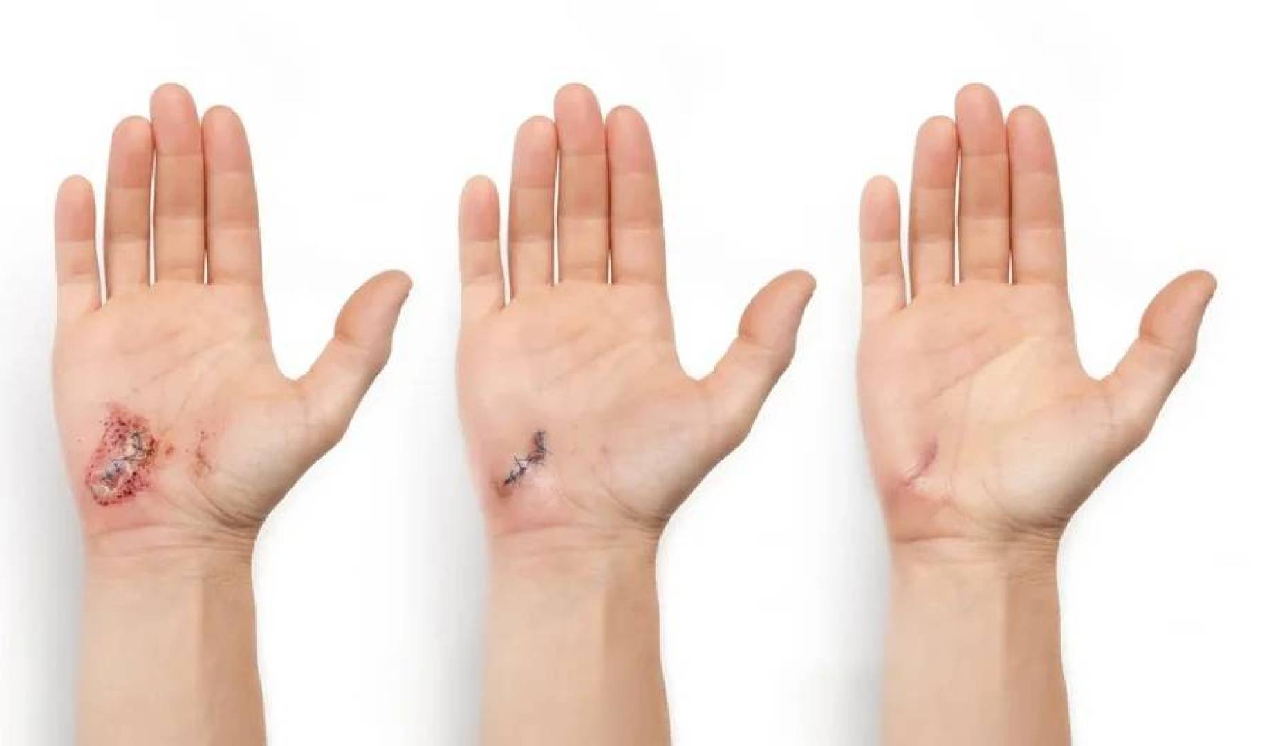 دواء صيني جديد يعيد الأمل لمرضى السكري من النوع الأول