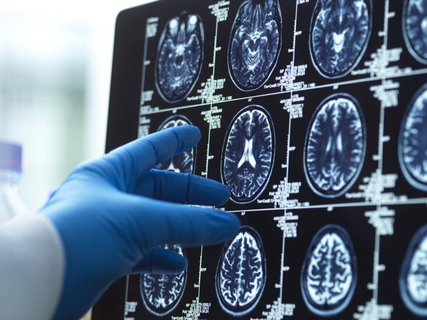 الإمارات تدعم مرضى الزهايمر وتطلق أول تجربة سريرية لتقنية الذكريات الاصطناعية
