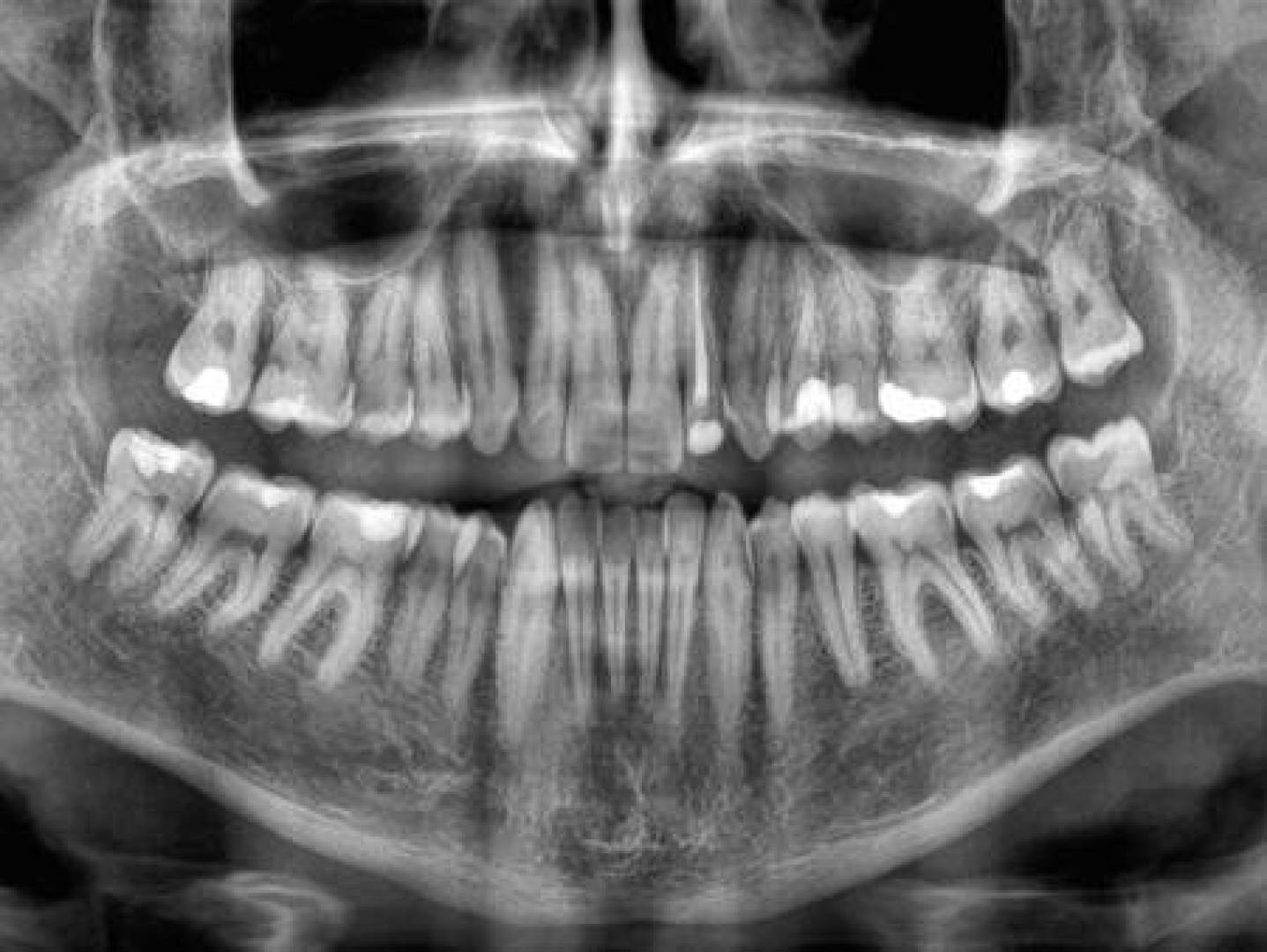 الكشف عن العلاقة بين تساقط الأسنان والموت المبكر الكشف عن العلاقة بين تساقط الأسنان والموت المبكر