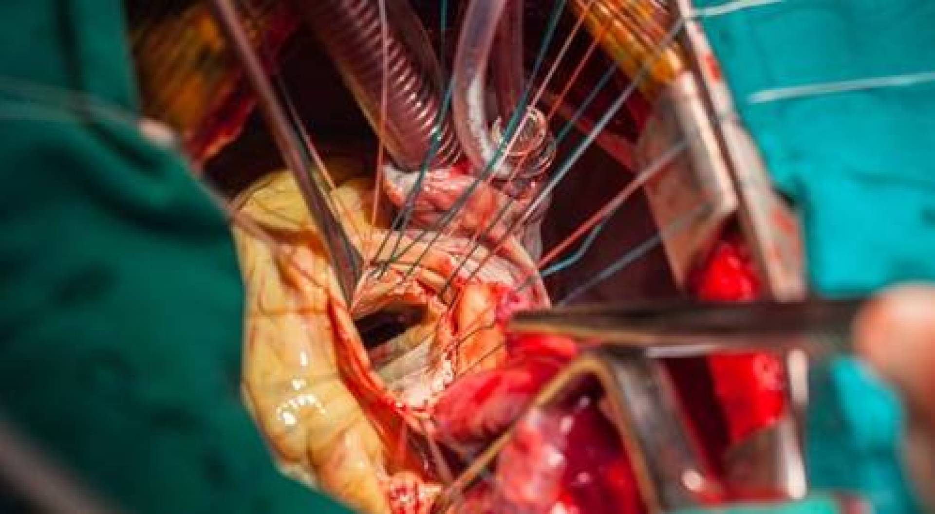 أول عملية تحويل مسار الشريان التاجي دون فتح الصدر