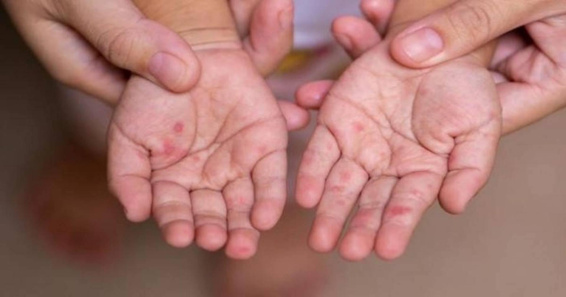 وزارة الزراعة الفلسطينية تحذر من سلالة غير مسبوقة للحمى القلاعية