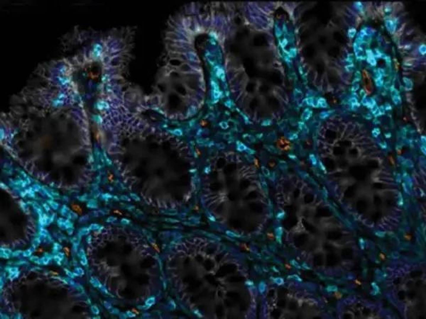 اكتشاف آلية جديدة تربط بين التمثيل الدهني ومرض الصدفية وعلاجه