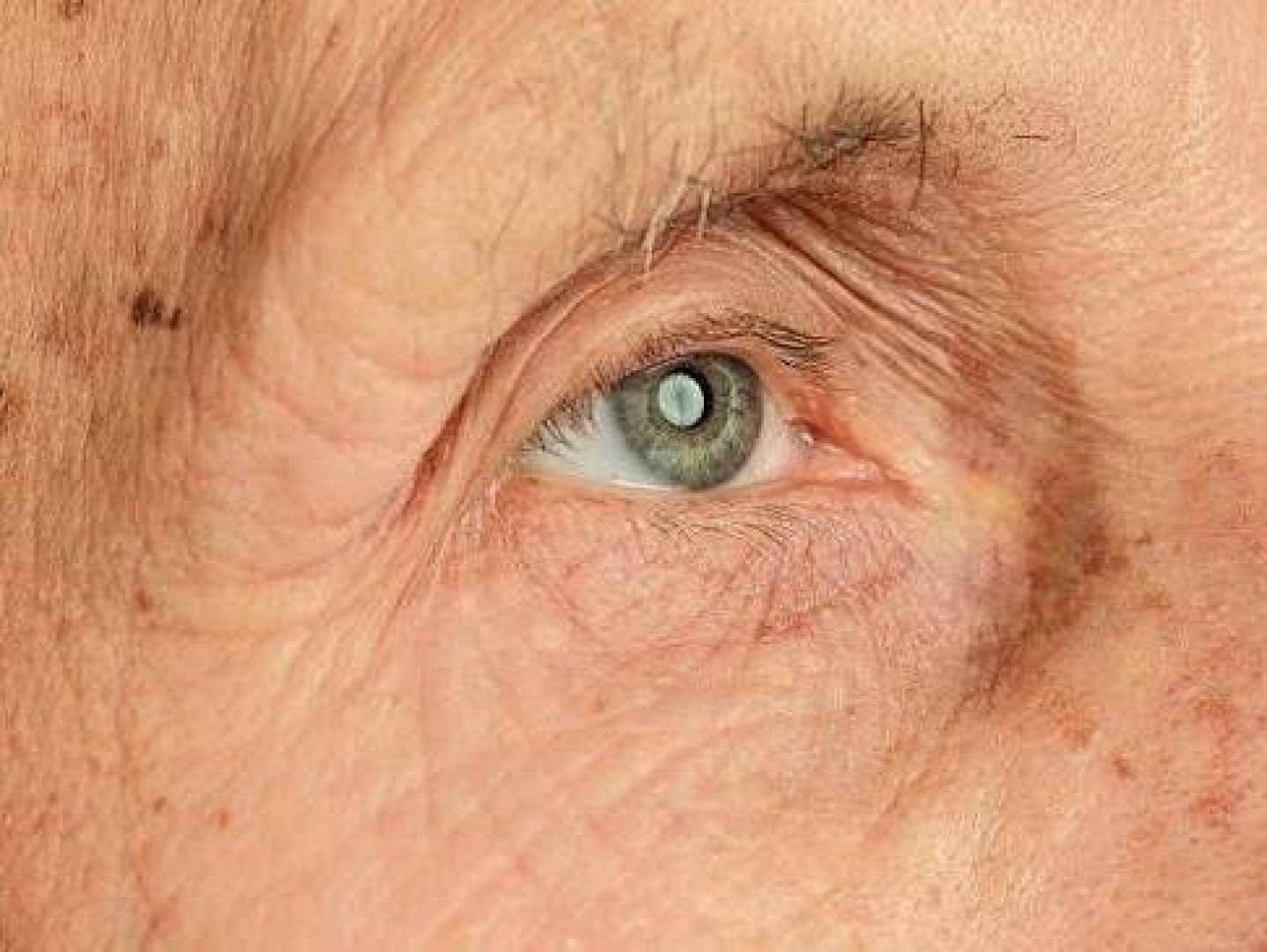 اكتشاف جيني جديد يزيد خطر فقدان البصر الحاد