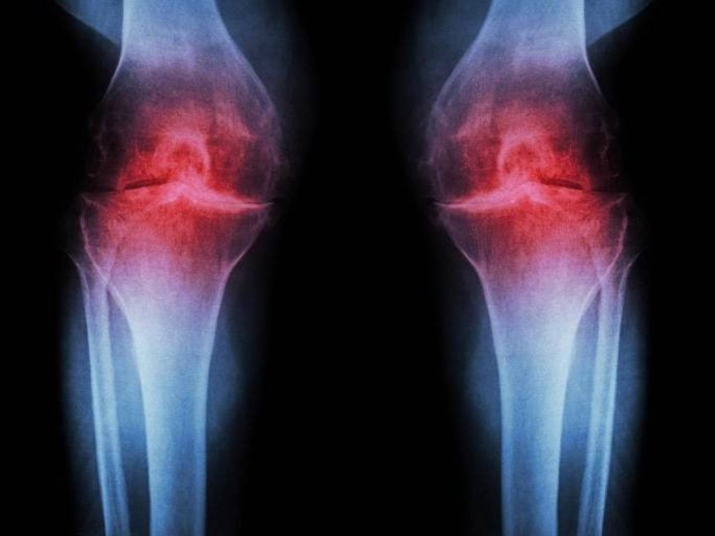 تقنية جديدة تكشف التهاب المفاصل الروماتويدي يبدأ قبل ظهور الألم بسنوات