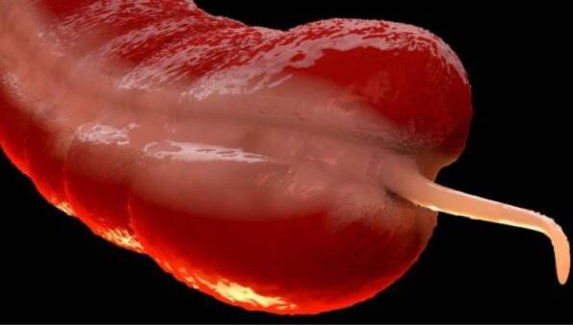 ارتفاع حاد في حالات سرطان الزائدة الدودية بين الشباب