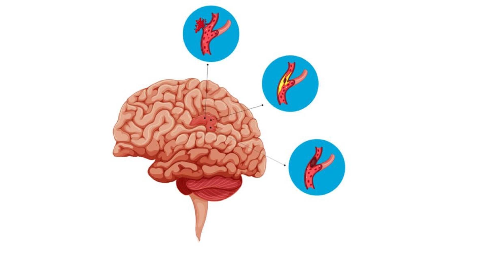 استخدام الطباعة ثلاثية الأبعاد لكشف أسرار السكتات الدماغية