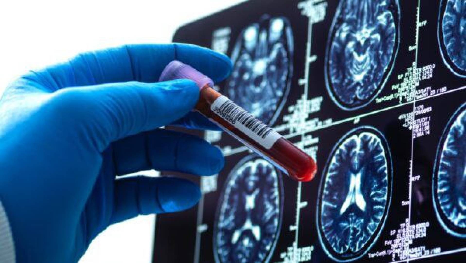 اكتشاف طفرات جديدة في جينات فصائل الدم لدى 3 أشخاص فقط في العالم