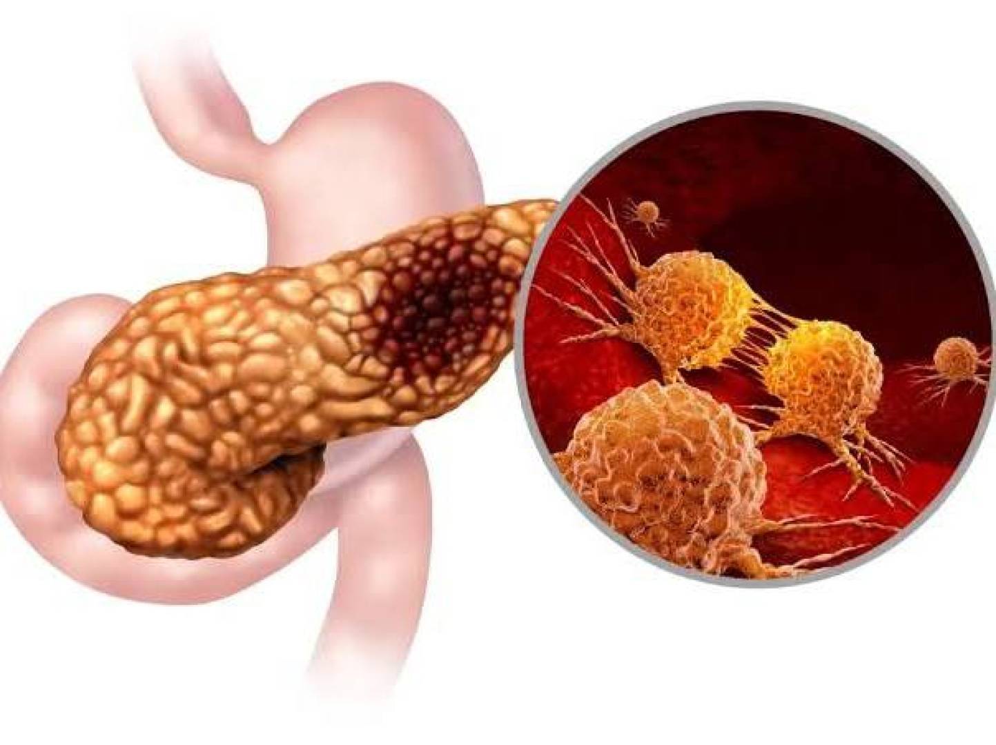 سرطان البنكرياس يتحدث لغة الأعضاء قبل أن يغزوها