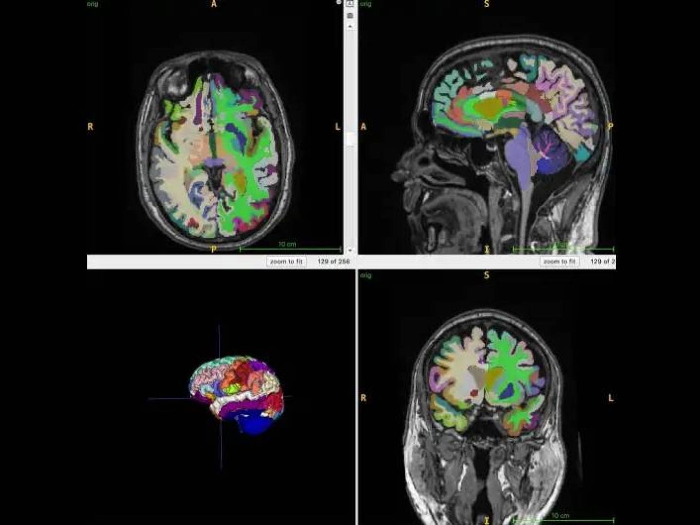 كتلة عضلات اكثر ودهون بطن أقل يبطئان شيخوخة الدماغ