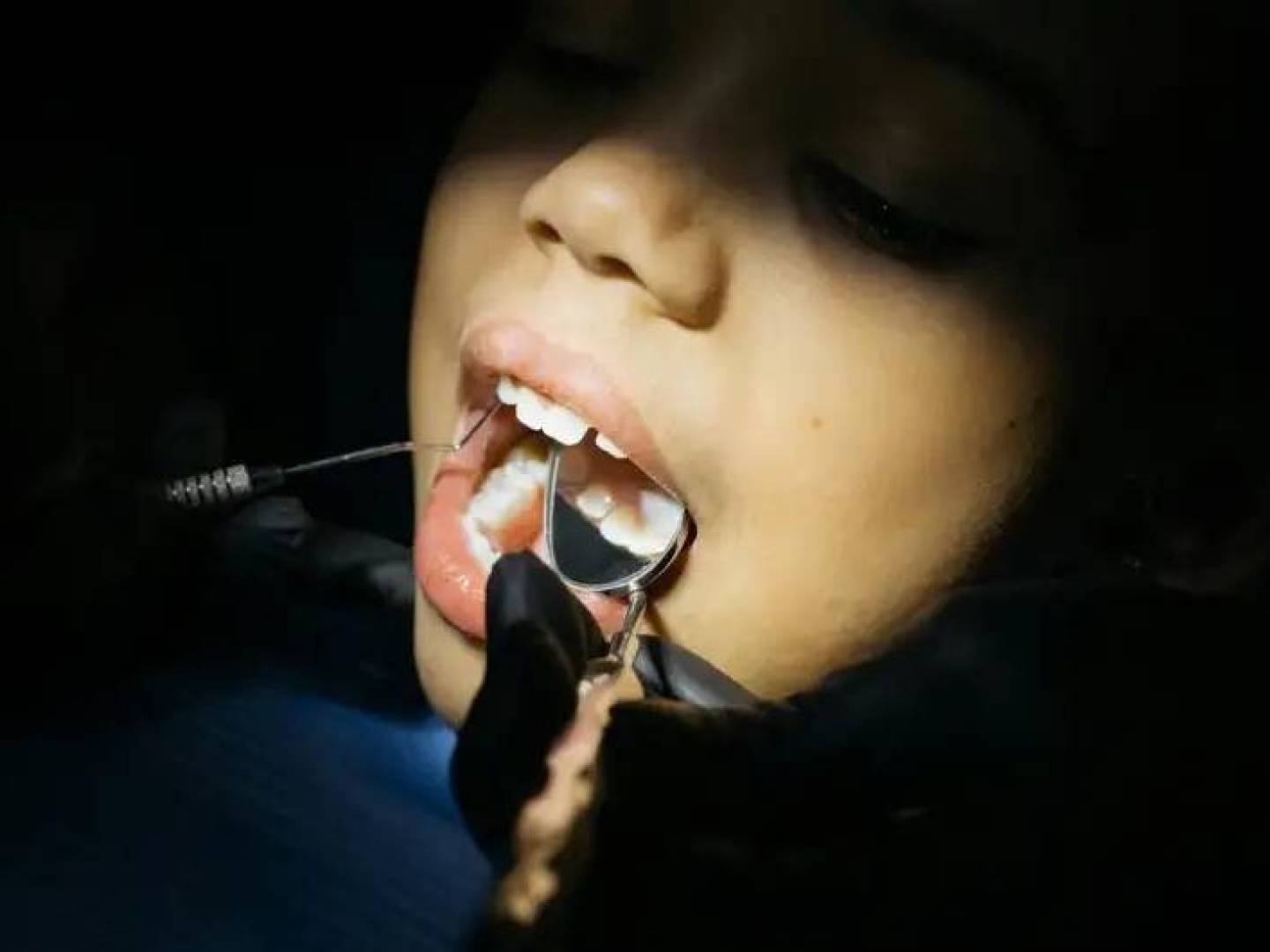 ابتكار رقمي يكشف التسوس المبكر عند الأطفال