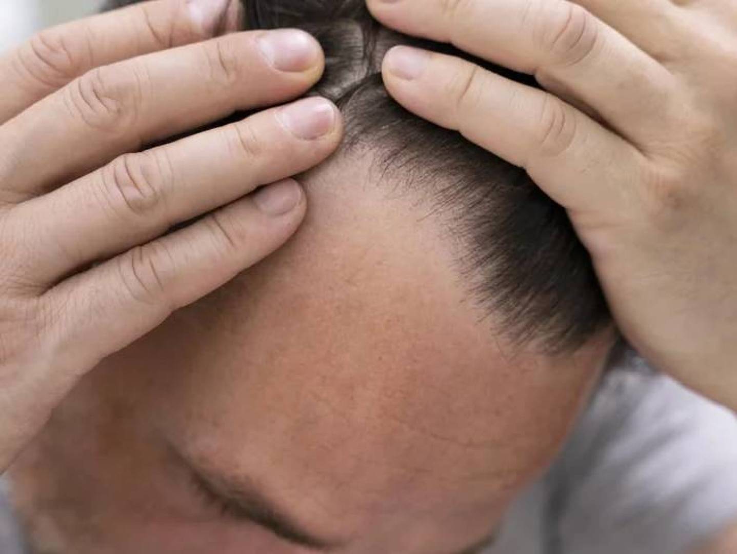 دهون الكبد وعلاقتها مع تساقط الشعر