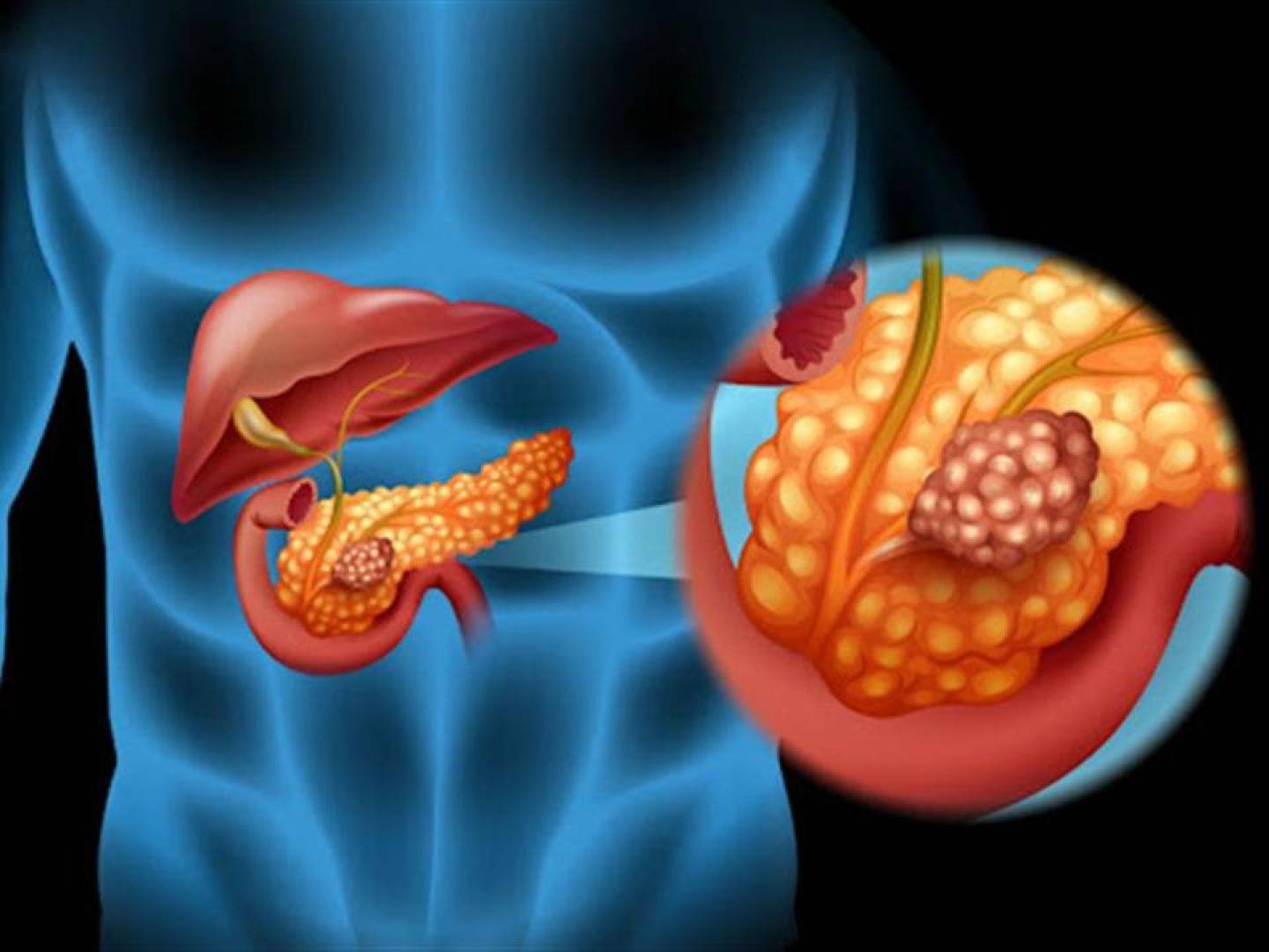 استراتيجية جديدة تعزز فعالية الأدوية في سرطان البنكرياس