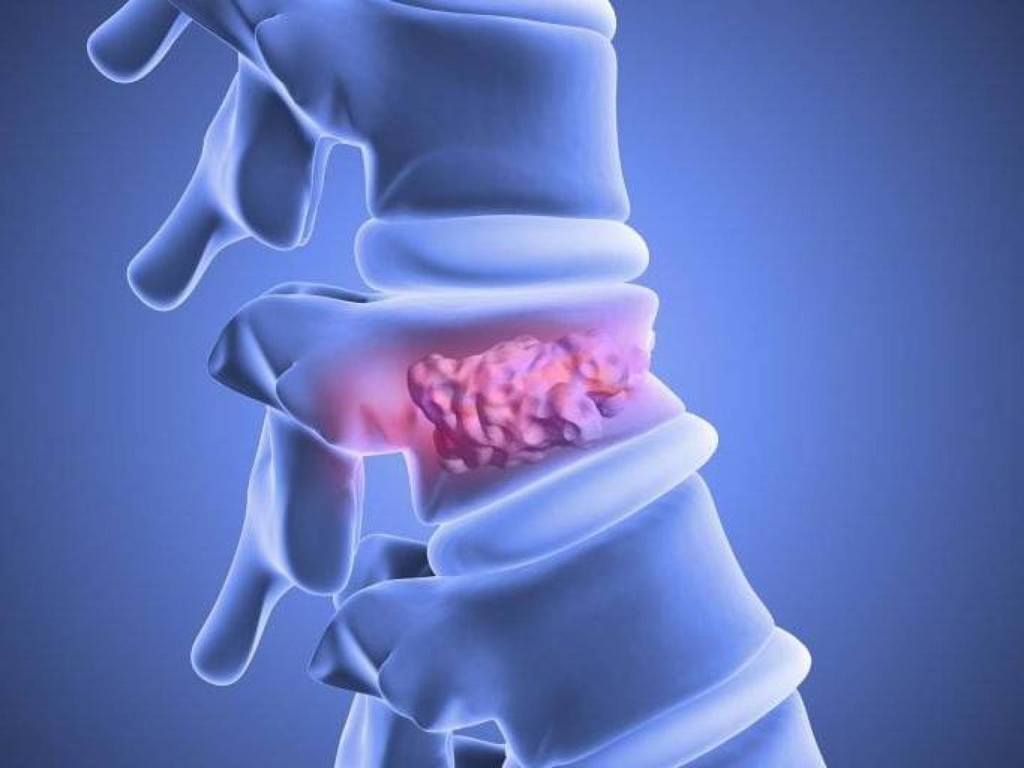 خلايا دهنية قادرة على شفاء كسور العمود الفقري وتحسين صحة العظام