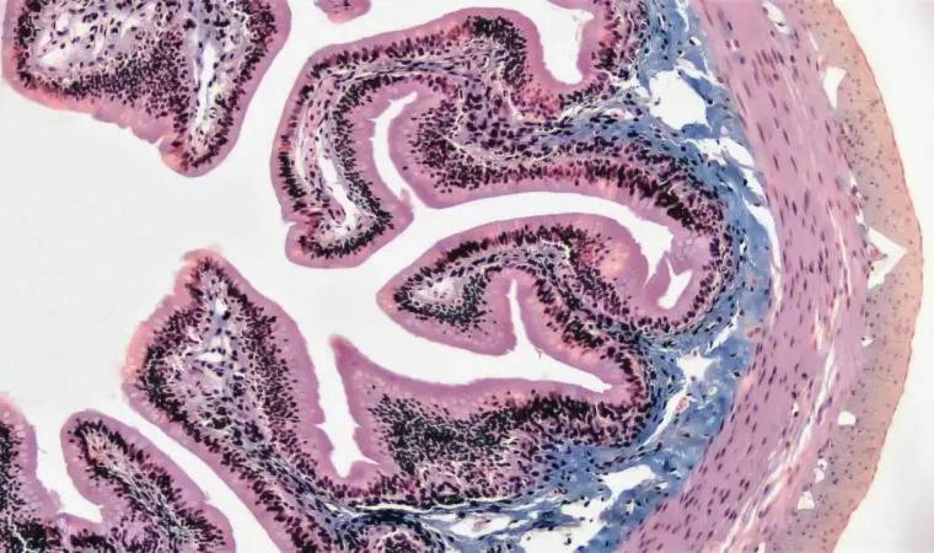 اكتشاف علمي هام يساعد في الكشف المبكر عن سرطان القولون