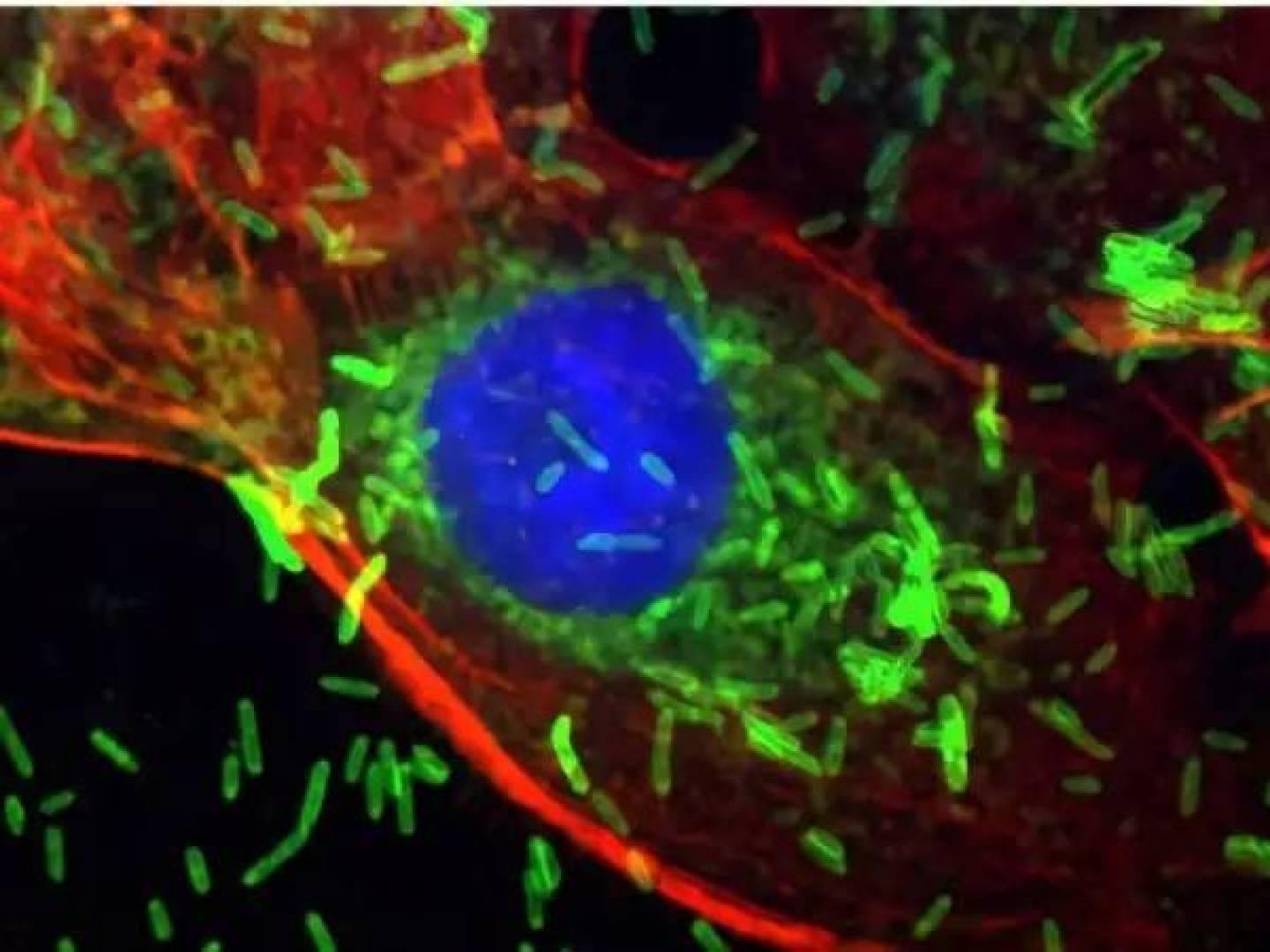 بكتيريا فموية مرتبطة بأمراض اللثة قد تسهم في تحفيز بداية سرطان الثدي