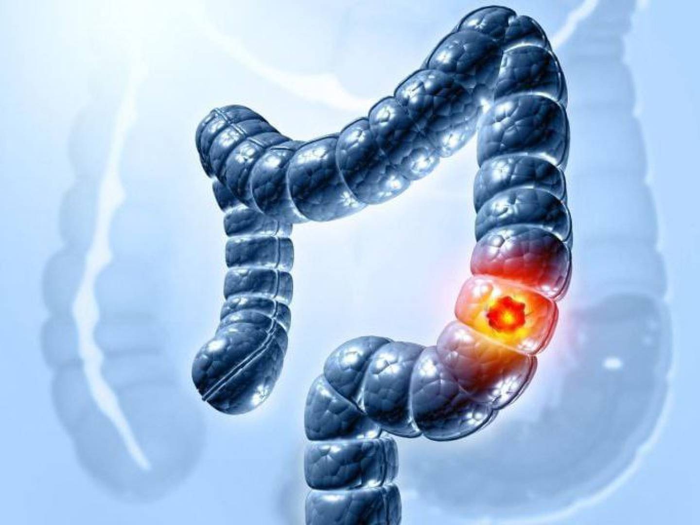 الالتهاب المزمن في القولون يمكن أن يزيد من صلابة أنسجته