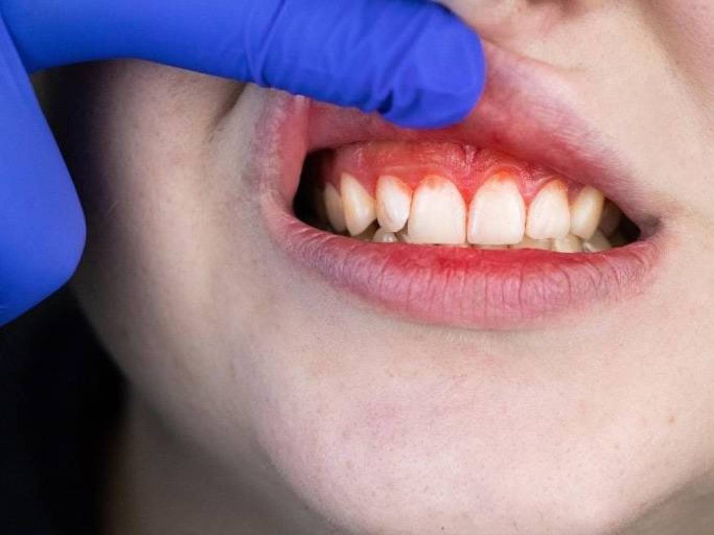 بكتيريا الفم المرتبطة باللثة قد تساهم في تطور سرطان الثدي