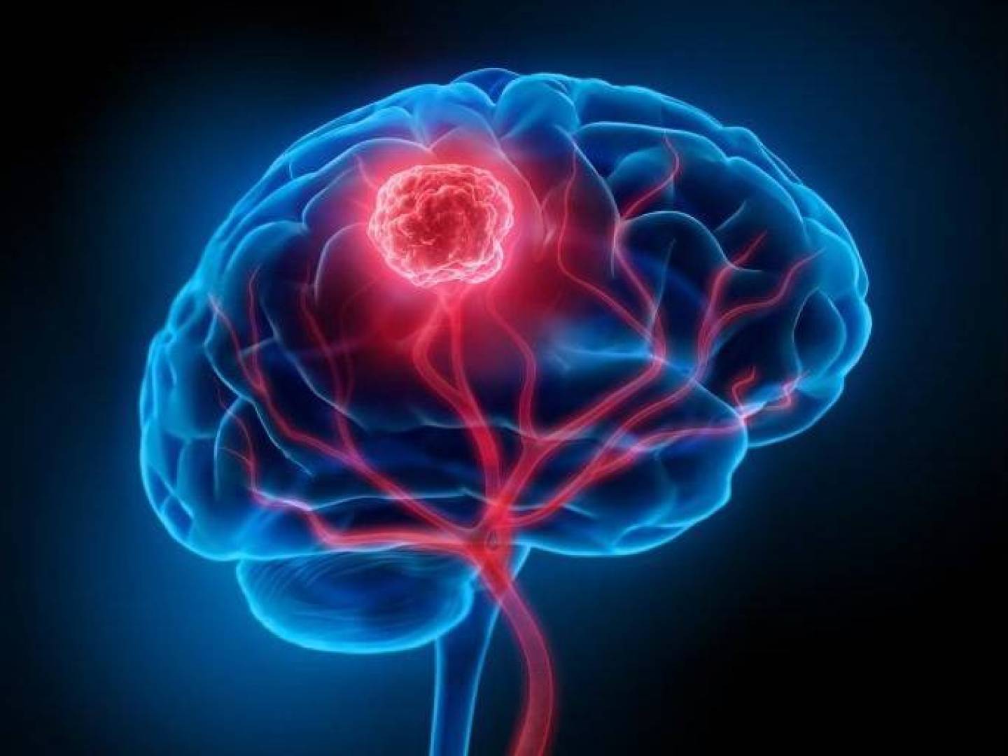 قطرات أنفية غير جراحية تنجح في القضاء على أخطر سرطان في الدماغ