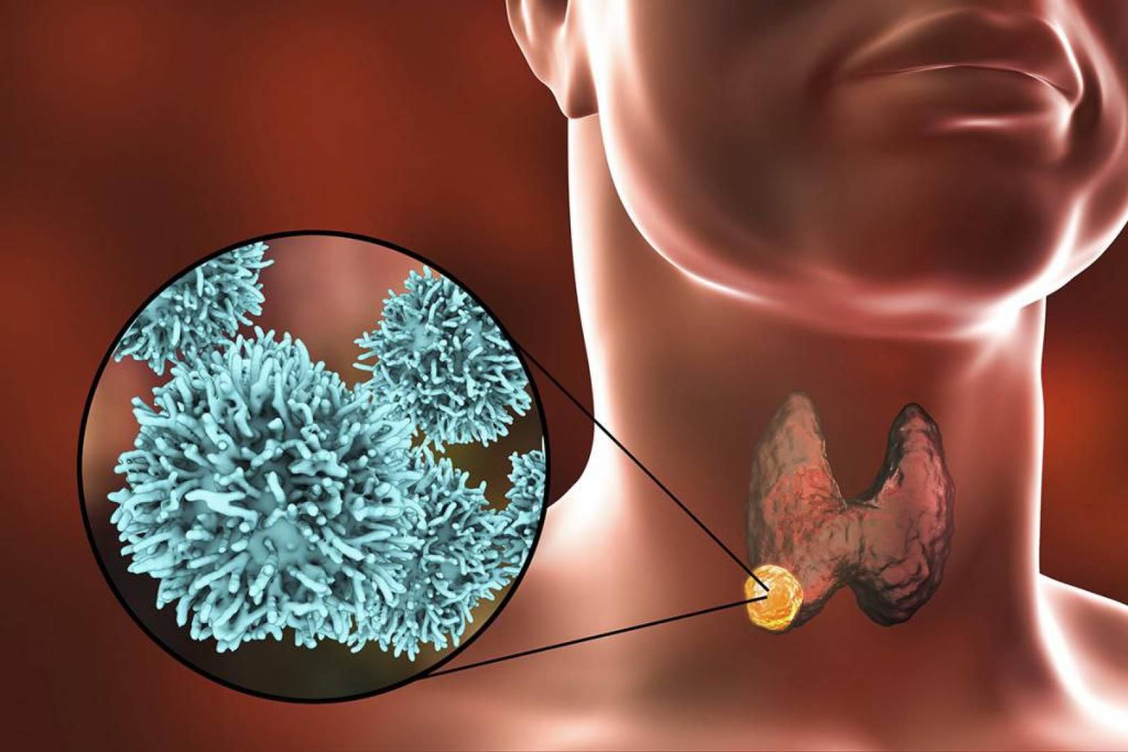 كل ماتريد معرفته عن عقيدات الغدة الدرقية