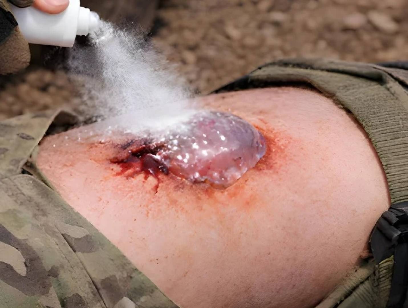 تطوير مسحوق طبي على شكل رذاذ يوقف النزيف الحاد خلال ثانية واحدة