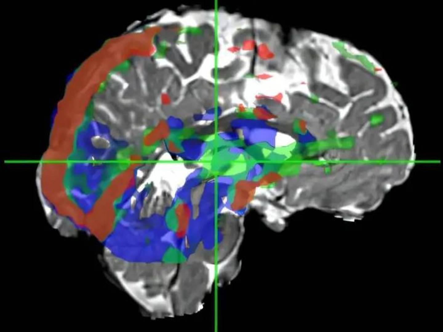 تقنية تصوير بالرنين المغناطيسي جديدة ترصد حركة السوائل في الدماغ وتساعد في كشف الزهايمر مبكراً