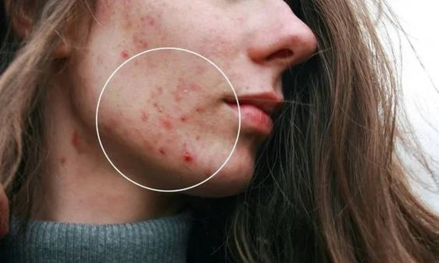 ابتكار لصقة ميكروإبر تعالج حب الشباب المستعصي بكفاءة