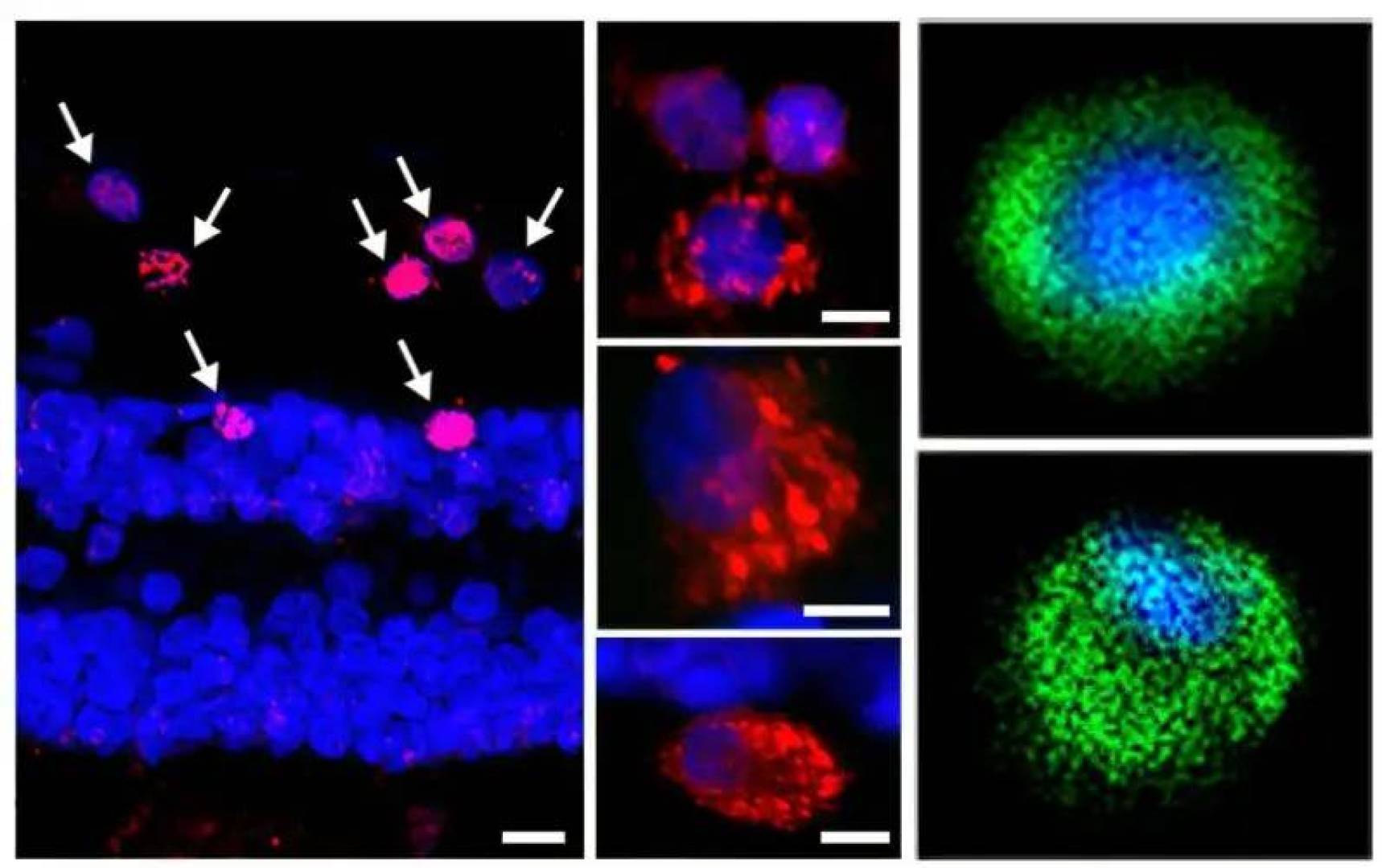 اكتشاف رابط جديد بين عدوى بكتيرية بالعين والزهايمر