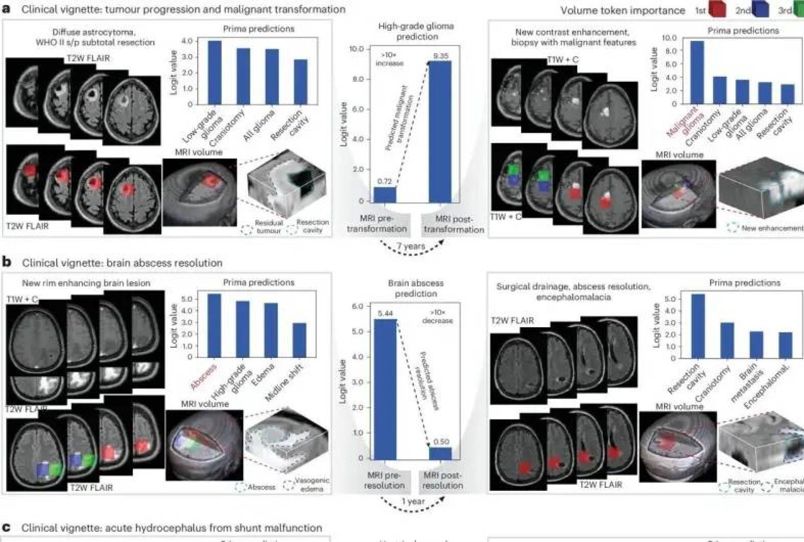 نموذج ذكاء اصطناعي يحلل صور الرنين المغناطيسي للدماغ ويشخيص الأمراض العصبية خلال ثوان
