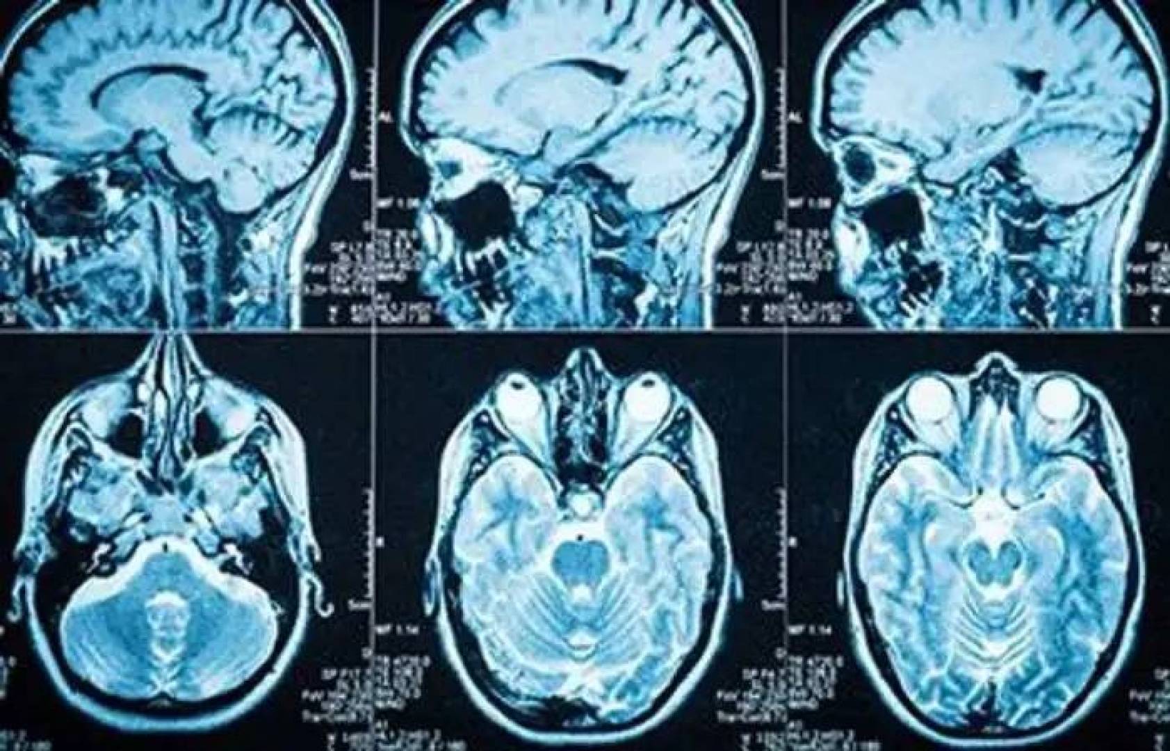 أنواع أورام الدماغ و الأعراض و التشخيص وخيارات العلاج