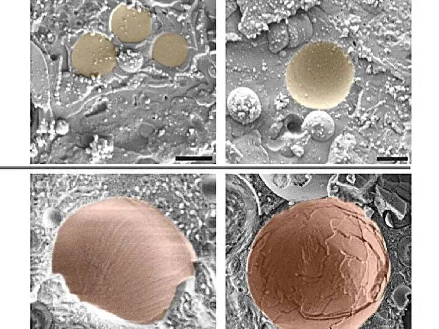 بلورات الكوليسترول قد تكون سبباً مبكراً لأمراض الكبد الخطيرة